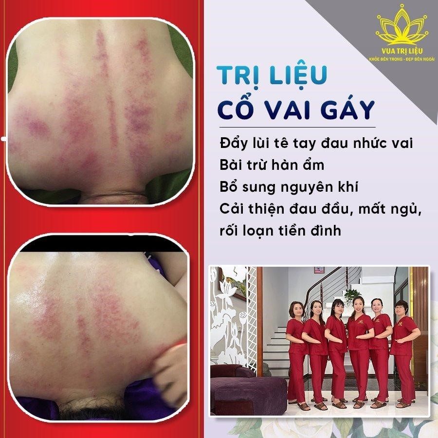 Massage trị liệu cổ vai gáy 99k tại Vua Trị Liệu