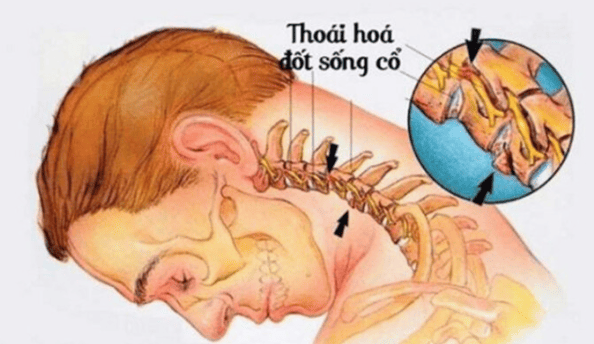 Thoái hóa đốt sống cổ ảnh hưởng đến sức khỏe nghiêm trọng